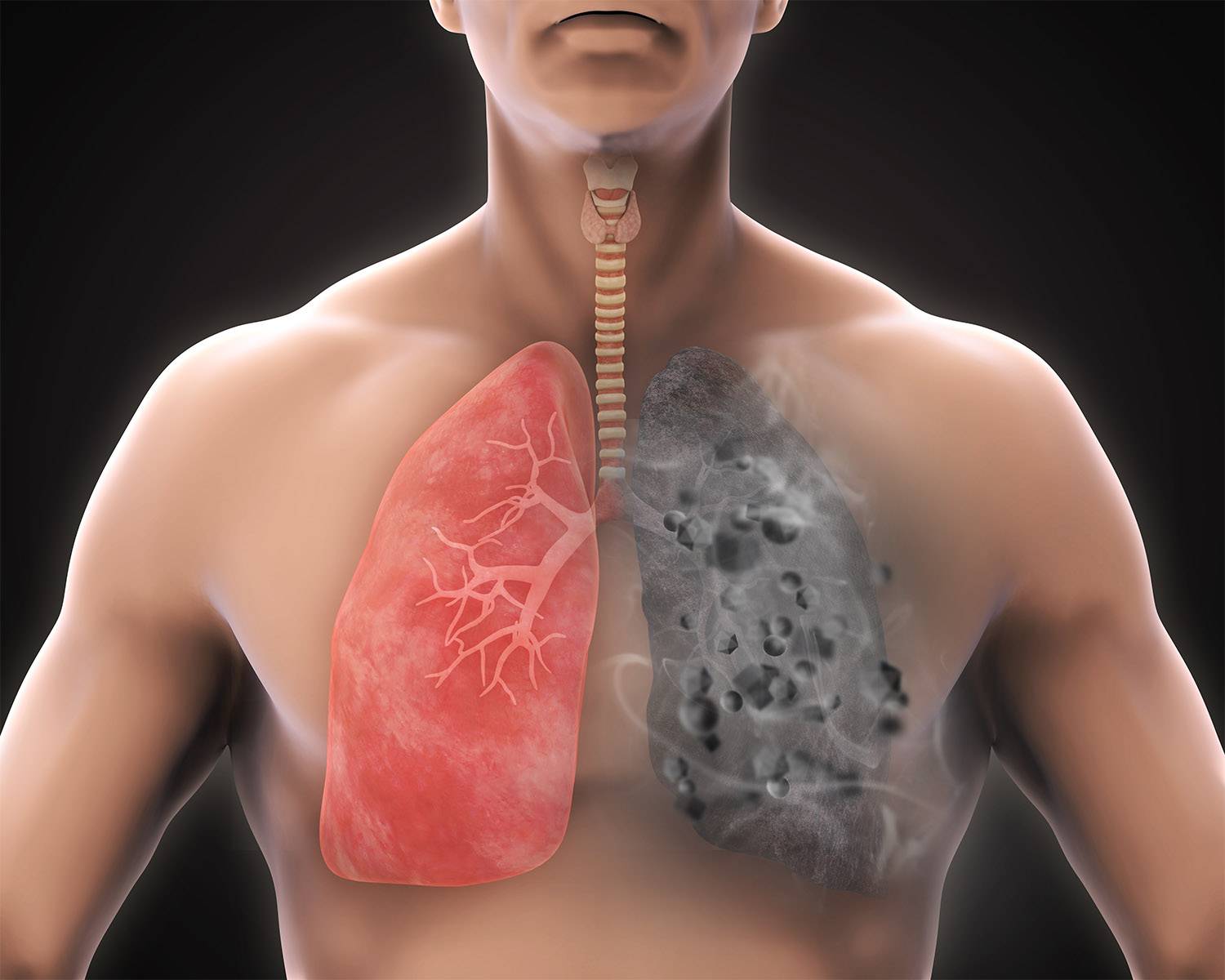 3D illustration of a healthy lung and one damaged by workplace dust.